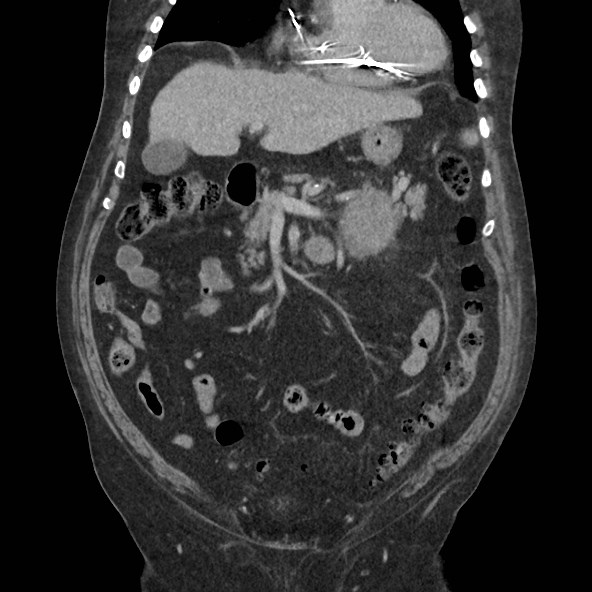 Adrenal lymphoma (Radiopaedia 84145-99415 Coronal C+ portal venous phase 29).jpg