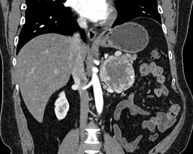 Adrenal metastases (Radiopaedia 73082-83791 Coronal C+ arterial phase 25).jpg