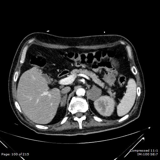 Adrenal metastasis (Radiopaedia 78425-91079 Axial C+ arterial phase 30).jpg