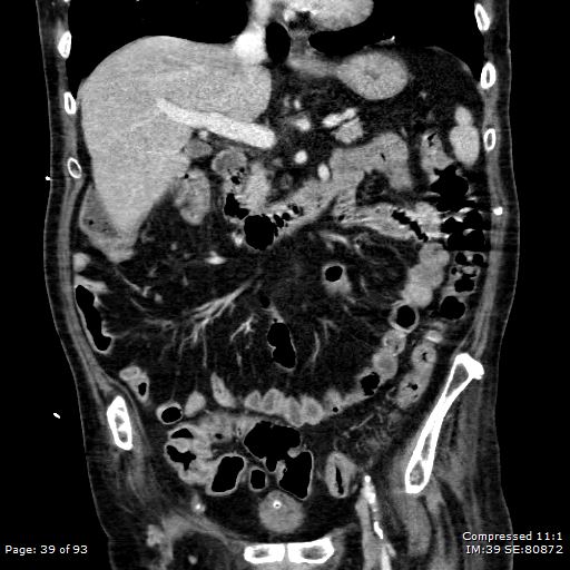 Adrenal metastasis (Radiopaedia 78425-91079 Sagittal C+ portal venous phase 26).jpg