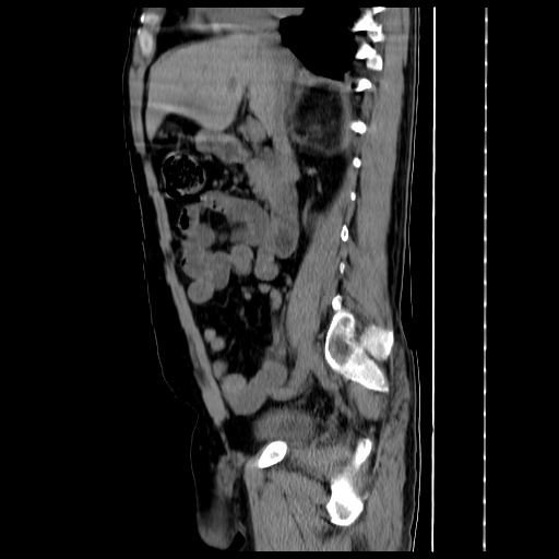 File:Adrenal myelolipoma (Radiopaedia 41843-44834 Sagittal non-contrast 18).jpg