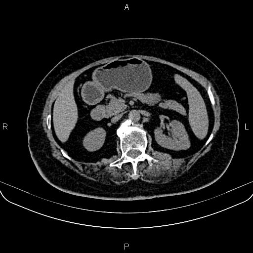 File:Adrenal myelolipoma (Radiopaedia 82742-96986 Axial non-contrast 59).jpg