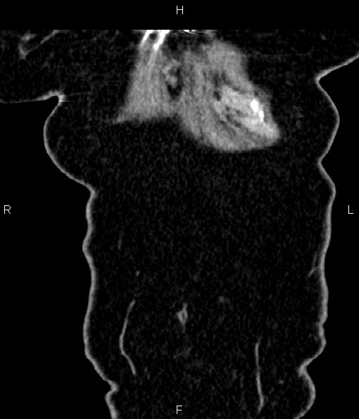 Adrenal myelolipoma (Radiopaedia 82742-96986 Coronal renal cortical phase 8).jpg