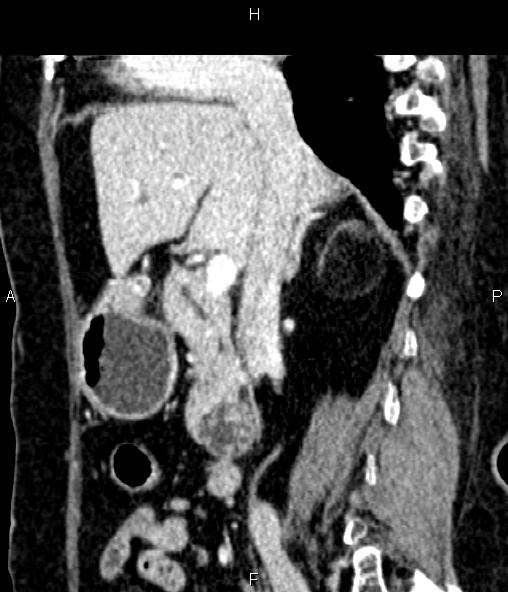 Adrenal myelolipoma (Radiopaedia 82742-96986 Sagittal renal cortical phase 48).jpg