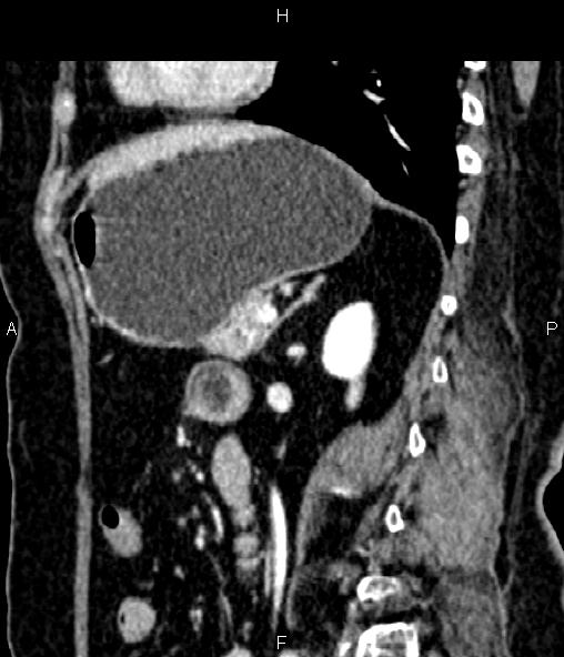 Adrenal myelolipoma (Radiopaedia 82742-96986 Sagittal renal cortical phase 69).jpg