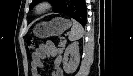Adrenal myelolipoma (Radiopaedia 84321-99619 Sagittal non-contrast 82).jpg