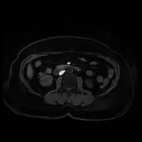 Adrenal myelolipoma - MRI (Radiopaedia 83249-97646 Axial T1 fat sat 55).jpg