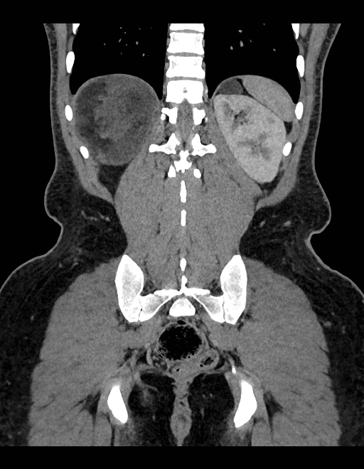 Adrenal myelolipoma - bilateral (Radiopaedia 74805-85810 Coronal C+ portal venous phase 86).jpg