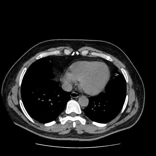 Adrenal myelolipoma and beaver tail liver (Radiopaedia 86201-102193 Axial non-contrast 2).jpg