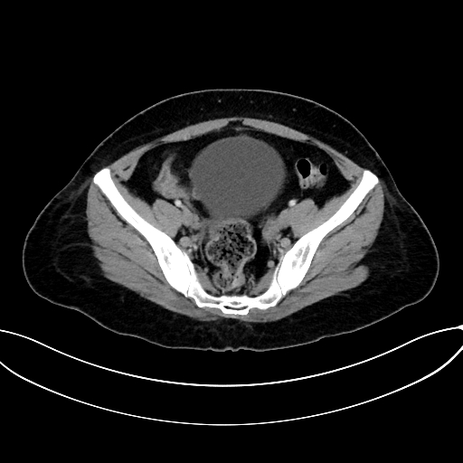 Adrenocortical carcinoma (Radiopaedia 87281-103569 Axial C+ portal venous phase 70).jpg