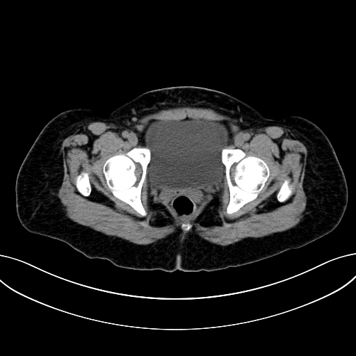 Adrenocortical carcinoma (Radiopaedia 87281-103569 Axial non-contrast 84).jpg