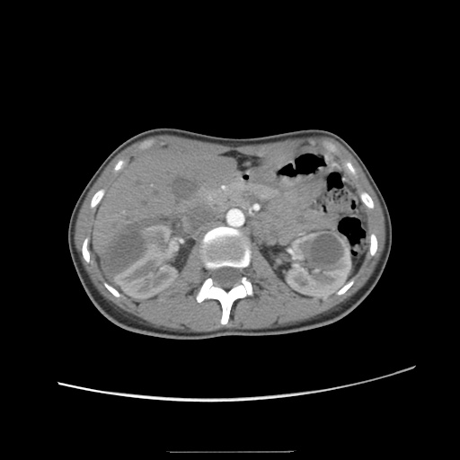 Adult polycystic kidney disease (Radiopaedia 48845-53876 Axial renal cortical phase 22).jpg
