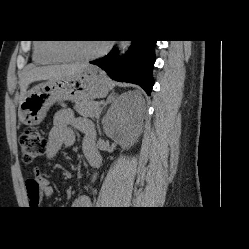 Adult polycystic kidney disease (Radiopaedia 59075-66368 Sagittal non-contrast 56).jpg