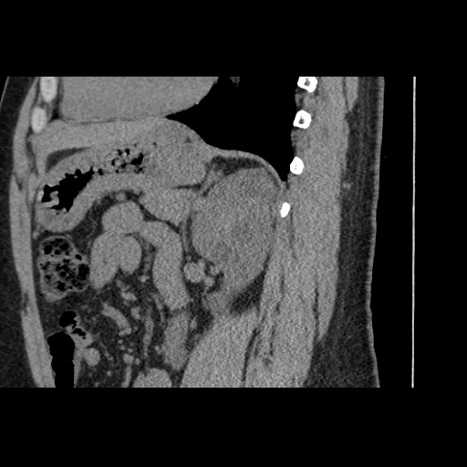 Adult polycystic kidney disease (Radiopaedia 59075-66368 Sagittal non-contrast 57).jpg