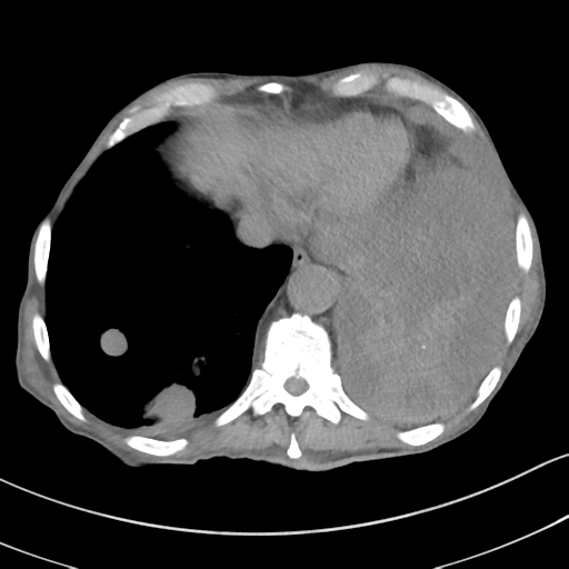 Advanced metastatic lung cancer (Radiopaedia 48910-53954 Axial non-contrast 50).png