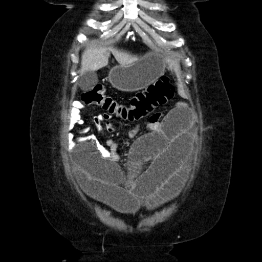 File:Afferent loop syndrome - secondary to incarcerated trocar site hernia (Radiopaedia 82959-97305 Coronal C+ portal venous phase 43).jpg