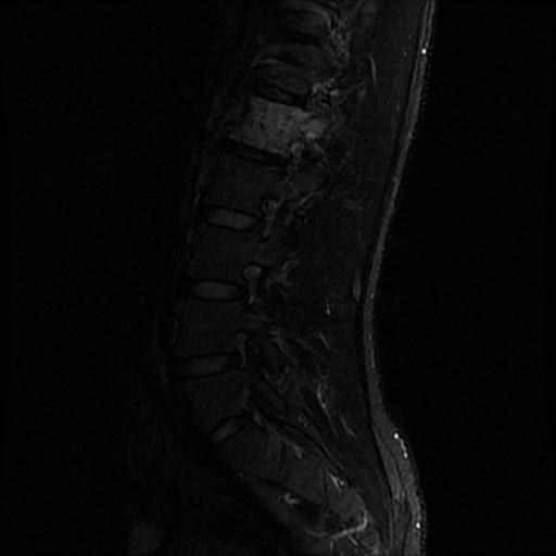 File:Aggressive vertebral hemangioma with pathological fracture (Radiopaedia 69528-79411 Sagittal STIR 2).jpg