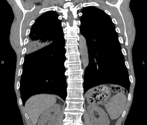 Air bronchogram in pneumonia (Radiopaedia 85719-101512 Coronal non-contrast 43).jpg