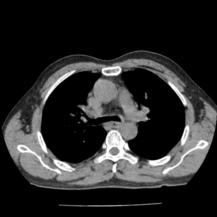 Airway foreign body in adult (Radiopaedia 85907-101779 Axial liver window 57).jpg