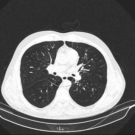 File:Allergic bronchopulmonary aspergillosis (Radiopaedia 21386-21320 Axial lung window 18).jpg