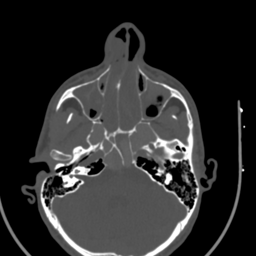 Allergic fungal sinusitis (Radiopaedia 88725-105456 Axial bone window 19).jpg