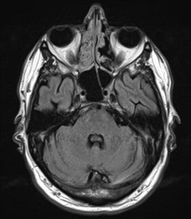 File:Alzheimer's disease- with Gerstmann syndrome and dressing apraxia (Radiopaedia 54882-61150 Axial FLAIR 7).png