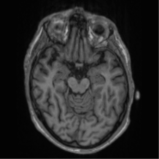 File:Alzheimer's disease- with apraxia (Radiopaedia 54763-61011 Axial T1 29).png