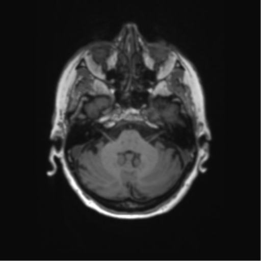 File:Alzheimer's disease (Radiopaedia 42658-45802 Axial T1 117).png