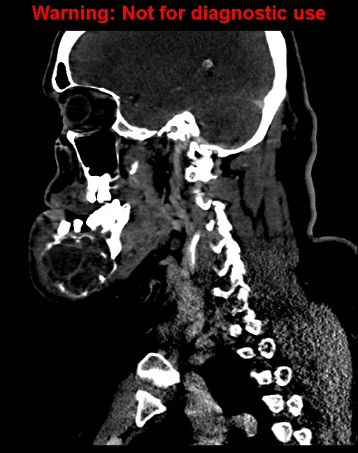 Ameloblastoma (Radiopaedia 33126-34164 F 46).jpg