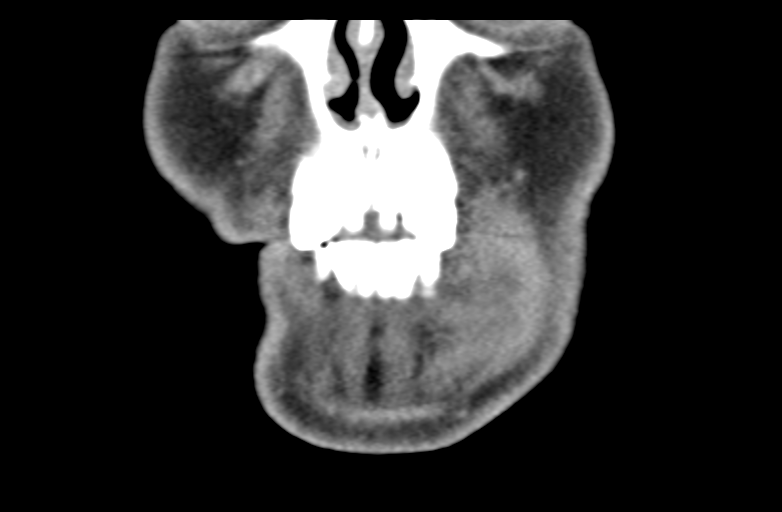 File:Ameloblastoma (Radiopaedia 33677-34806 Coronal non-contrast 14).png