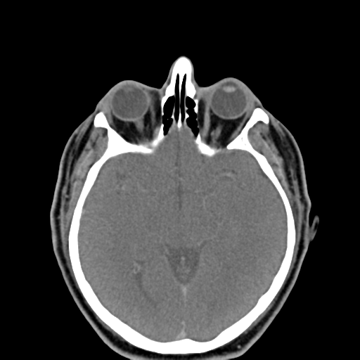 File:Ameloblastoma (Radiopaedia 38520-40623 Axial non-contrast 2).png