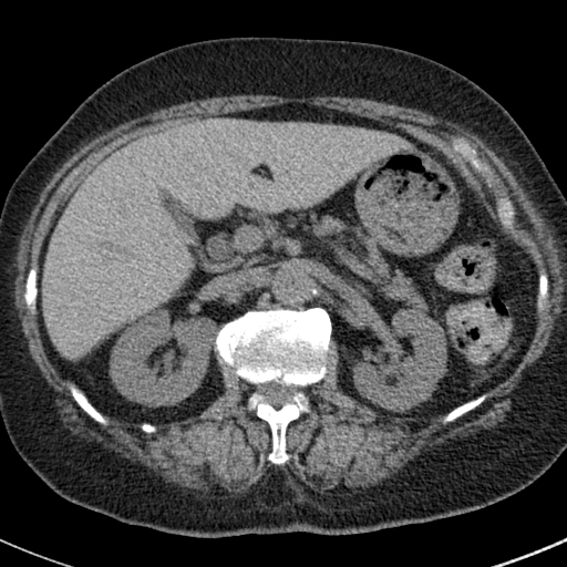 File:Amiodarone-induced pulmonary fibrosis (Radiopaedia 82355-96460 Axial non-contrast 64).jpg