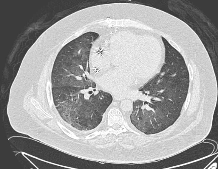 Amiodarone lung (Radiopaedia 62514-70769 Axial lung window 52).jpg