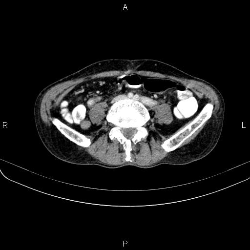 File:Ampullary adenocarcinoma (Radiopaedia 86093-102033 B 84).jpg