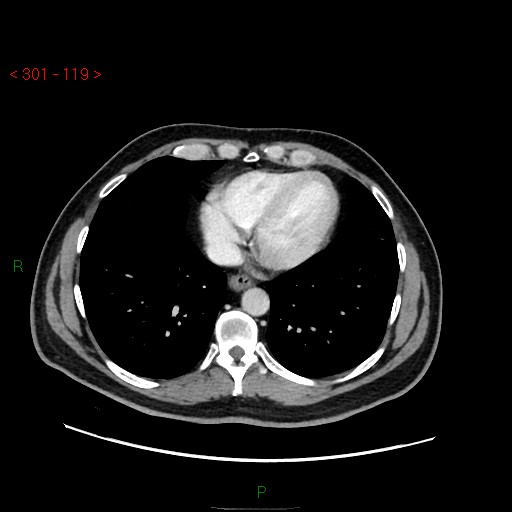 Ampullary carcinoma (Radiopaedia 56396-63056 C 7).jpg