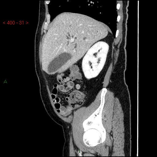 Ampullary carcinoma (Radiopaedia 56396-63056 D 30).jpg