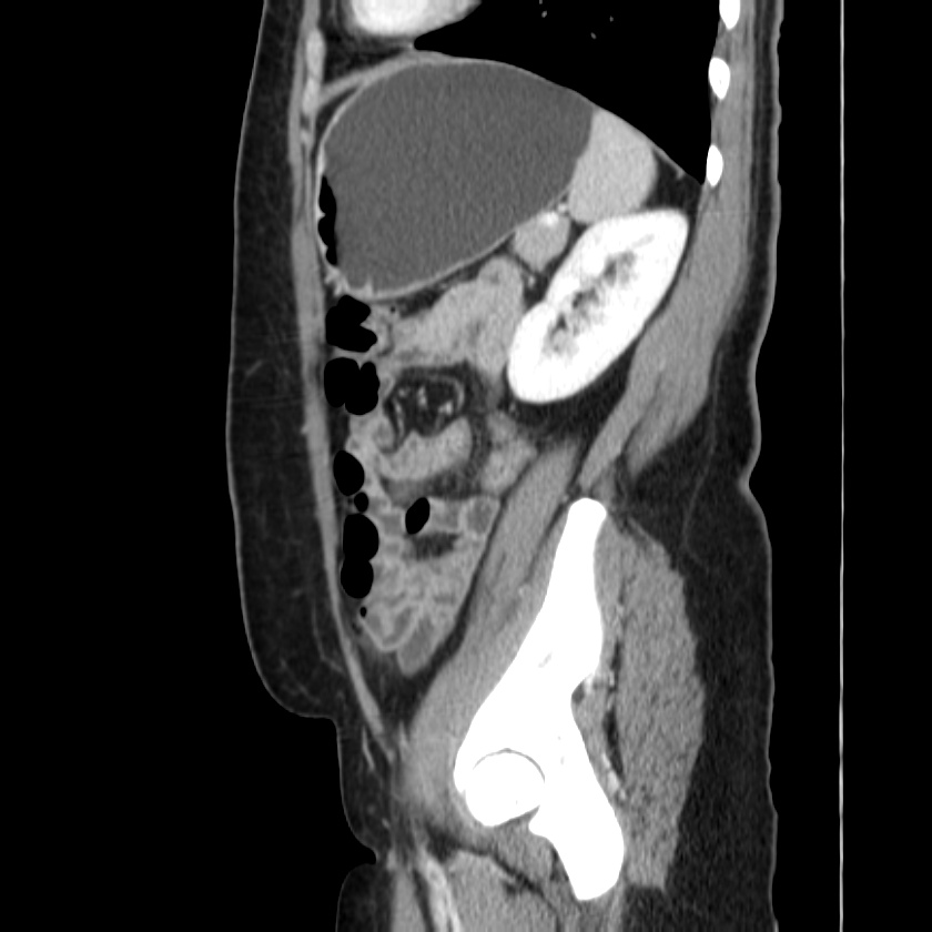 Ampullary tumor (Radiopaedia 22787-22816 D 41).jpg