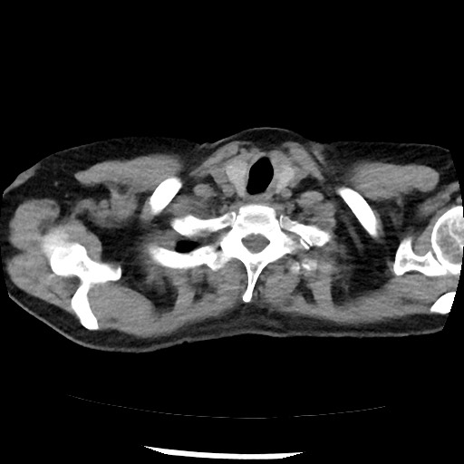 Amyloidosis - bronchial and diffuse nodular pulmonary involvement (Radiopaedia 60156-67744 Axial non-contrast 4).jpg