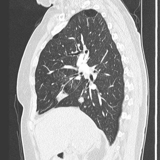 Amyloidosis - bronchial and diffuse nodular pulmonary involvement (Radiopaedia 60156-67745 Sagittal lung window 33).jpg