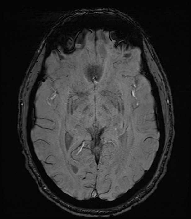 Amyotrophic lateral sclerosis (Radiopaedia 87352-103658 Axial SWI 25).jpg