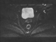 Anal adenocarcinoma - tumor regression grade 1 (Radiopaedia 31358-32100 Axial DWI 50).jpg
