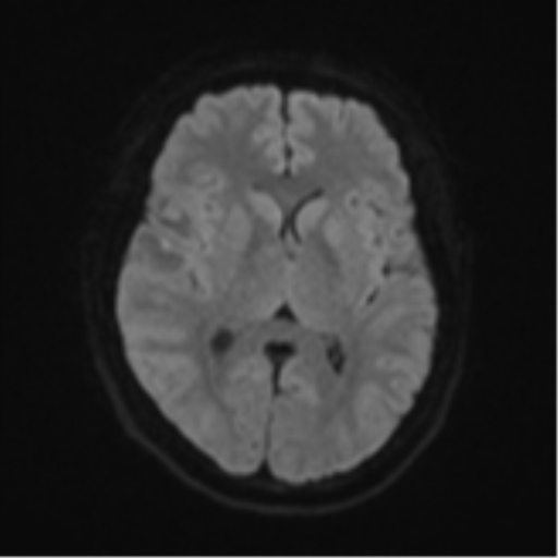 File:Anaplastic astroblastoma (Radiopaedia 55666-62194 Axial DWI 43).png