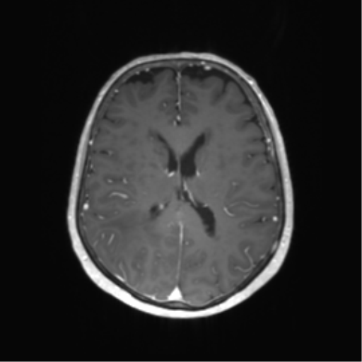 File:Anaplastic astrocytoma (Radiopaedia 86943-103160 Axial T1 C+ 40).png
