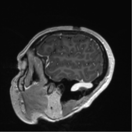 Anaplastic astrocytoma IDH mutant (Radiopaedia 50046-55341 Sagittal T1 C+ 51).png