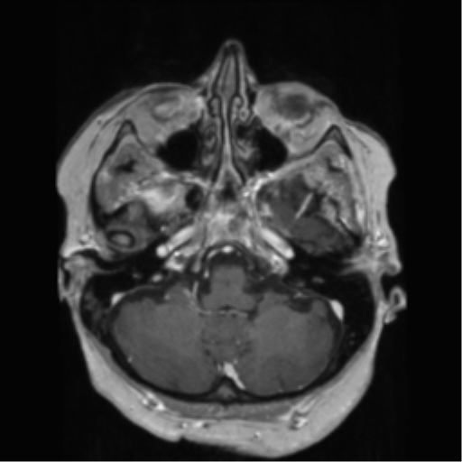 File:Anaplastic astrocytoma IDH wild-type (pseudoprogression) (Radiopaedia 42209-45278 Axial T1 C+ 42).png