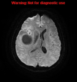 File:Anaplastic ganglioglioma (Radiopaedia 44921-48831 Axial DWI 17).jpg