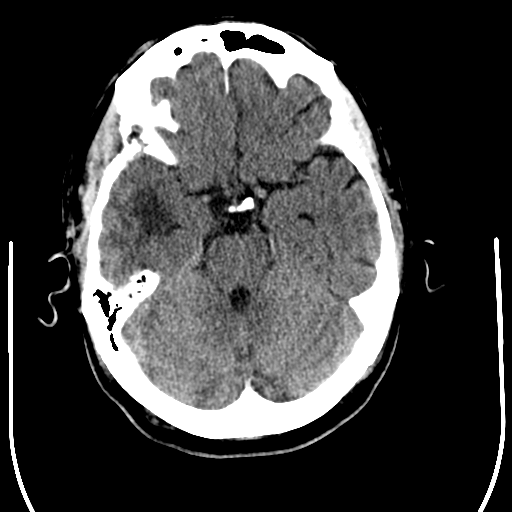 File:Anaplastic meningioma with recurrence (Radiopaedia 34452-35781 Axial non-contrast 11).png