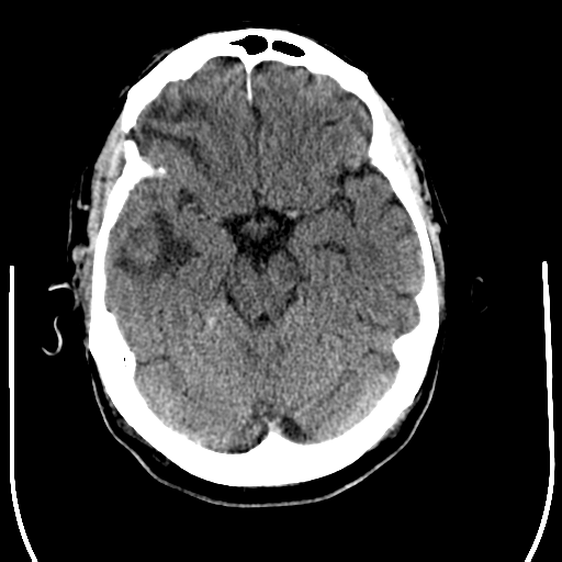 File:Anaplastic meningioma with recurrence (Radiopaedia 34452-35781 Axial non-contrast 12).png