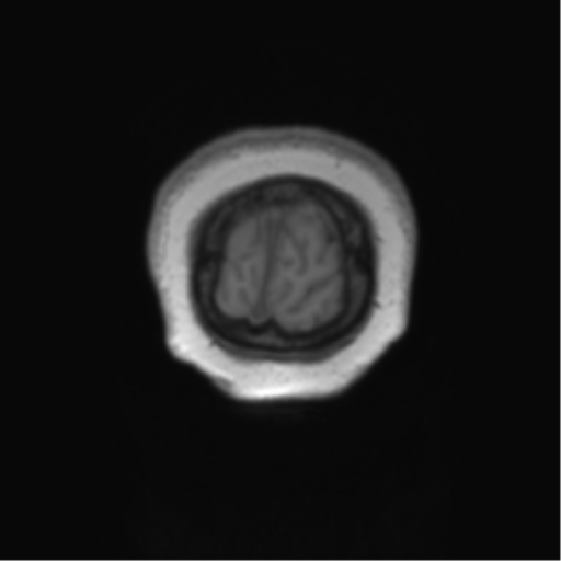 Anaplastic oligodendroglioma (Radiopaedia 83500-98599 Coronal T1 8).png