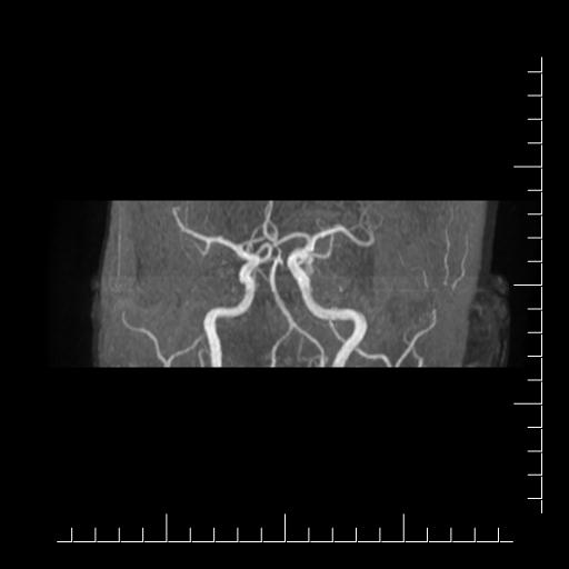 File:Aneurysm of posterior communicating artery (Radiopaedia 20188-20163 MRA 10).jpg